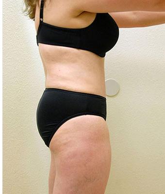 Tummy Tuck Before & After Patient #1217