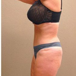 Tummy Tuck Before & After Patient #1218