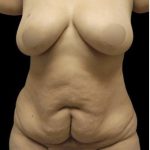Tummy Tuck Before & After Patient #1200