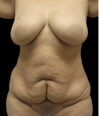 Tummy Tuck Before & After Patient #1200