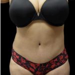 Tummy Tuck Before & After Patient #1200