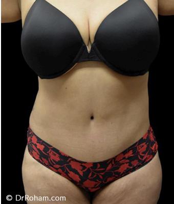 Tummy Tuck Before & After Patient #1200