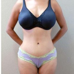 Tummy Tuck Before & After Patient #1219