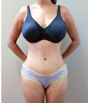 Tummy Tuck Before & After Patient #1219