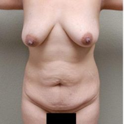 Tummy Tuck Before & After Patient #1220