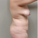 Tummy Tuck Before & After Patient #1220