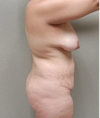 Tummy Tuck Before & After Patient #1220