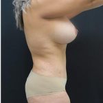 Tummy Tuck Before & After Patient #1220
