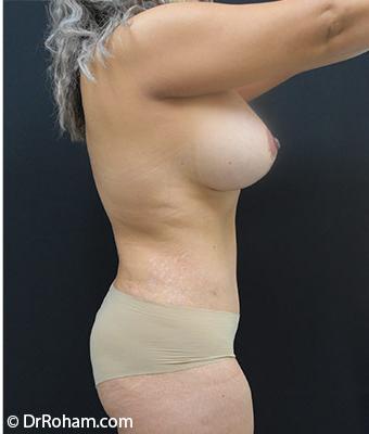 Tummy Tuck Before & After Patient #1220