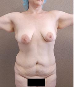 Tummy Tuck Before & After Patient #1221