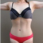 Tummy Tuck Before & After Patient #1221