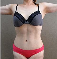 Tummy Tuck Before & After Patient #1221