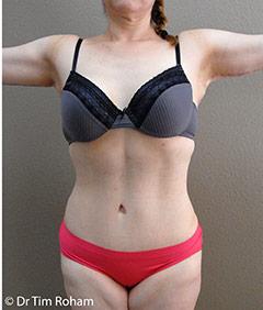 Tummy Tuck Before & After Patient #1221