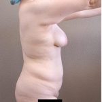 Tummy Tuck Before & After Patient #1221