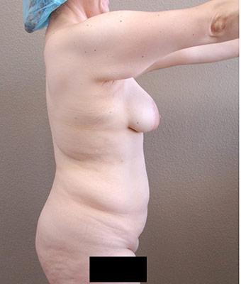 Tummy Tuck Before & After Patient #1221