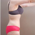 Tummy Tuck Before & After Patient #1221
