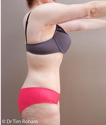 Tummy Tuck Before & After Patient #1221