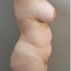Tummy Tuck Before & After Patient #1222