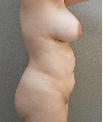 Tummy Tuck Before & After Patient #1222