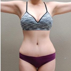 Tummy Tuck Before & After Patient #1223