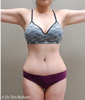 Tummy Tuck Before & After Patient #1223