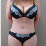 Tummy Tuck Before & After Patient #1224