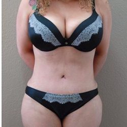 Tummy Tuck Before & After Patient #1224
