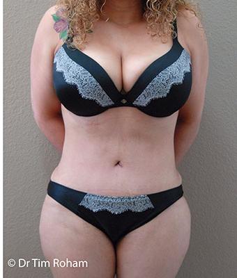 Tummy Tuck Before & After Patient #1224
