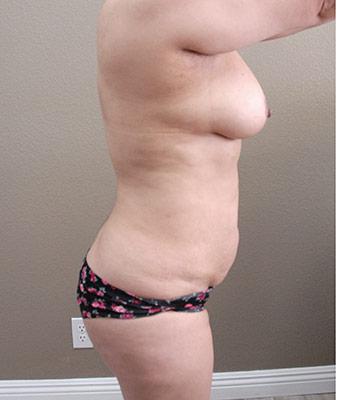 Tummy Tuck Before & After Patient #1224