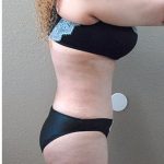 Tummy Tuck Before & After Patient #1224