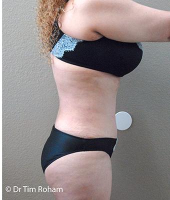 Tummy Tuck Before & After Patient #1224