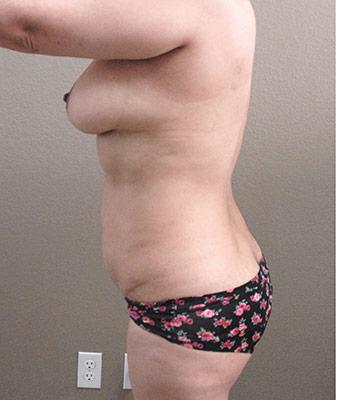Tummy Tuck Before & After Patient #1224
