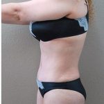 Tummy Tuck Before & After Patient #1224
