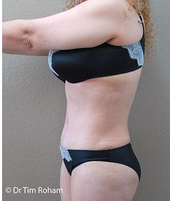 Tummy Tuck Before & After Patient #1224