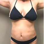 Tummy Tuck Before & After Patient #1225