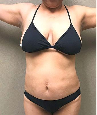 Tummy Tuck Before & After Patient #1225
