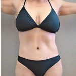 Tummy Tuck Before & After Patient #1225