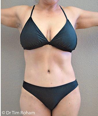 Tummy Tuck Before & After Patient #1225