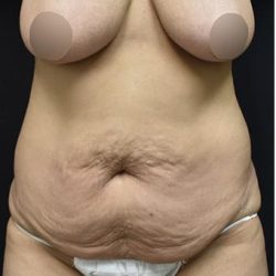 Tummy Tuck Before & After Patient #1201