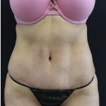 Tummy Tuck Before & After Patient #1201