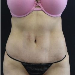 Tummy Tuck Before & After Patient #1201