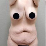 Tummy Tuck Before & After Patient #1202