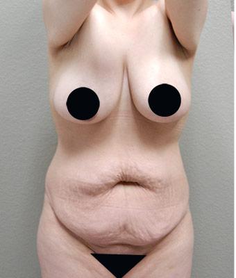 Tummy Tuck Before & After Patient #1202