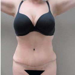 Tummy Tuck Before & After Patient #1202