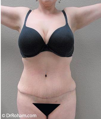 Tummy Tuck Before & After Patient #1202