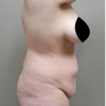 Tummy Tuck Before & After Patient #1202