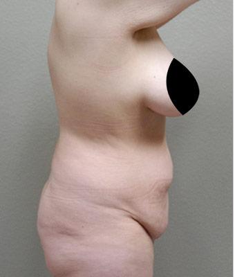 Tummy Tuck Before & After Patient #1202