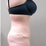 Tummy Tuck Before & After Patient #1202