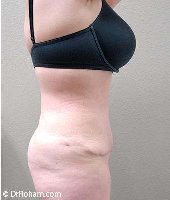 Tummy Tuck Before & After Patient #1202