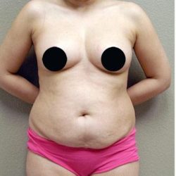 Tummy Tuck Before & After Patient #1203